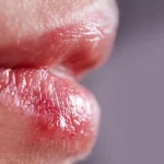 CómoCurarElHerpesLabial