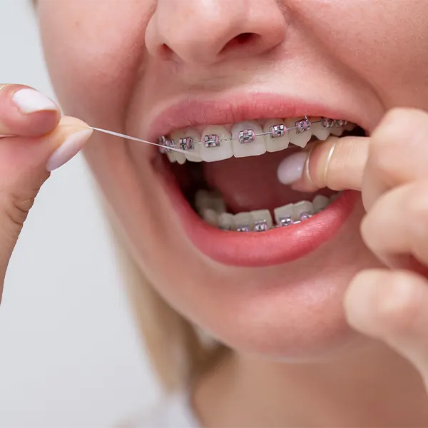 ¿Cómo limpiar tus brackets con un irrigador dental? Guía fácil