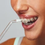 ¿Cómo limpiar tus brackets con un irrigador dental? Guía fácil