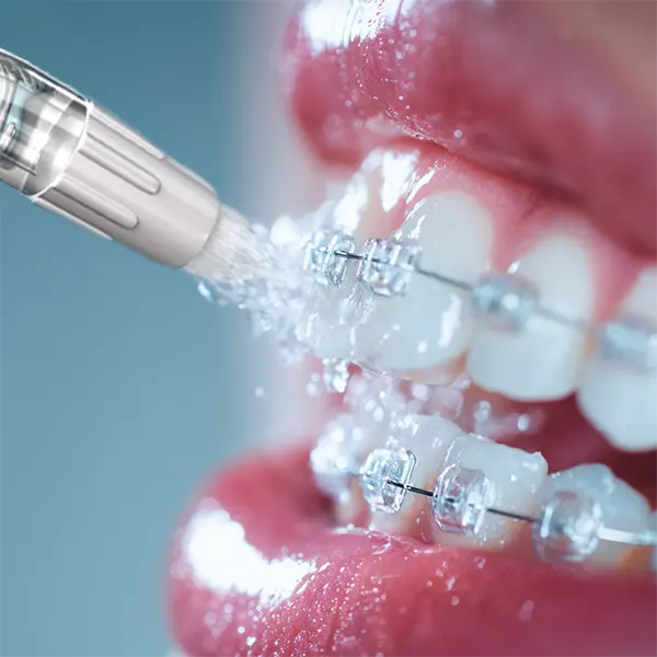 Irrigador bucal y ortodoncia invisible: lo que debes saber