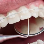Irrigador bucal y ortodoncia invisible: lo que debes saber