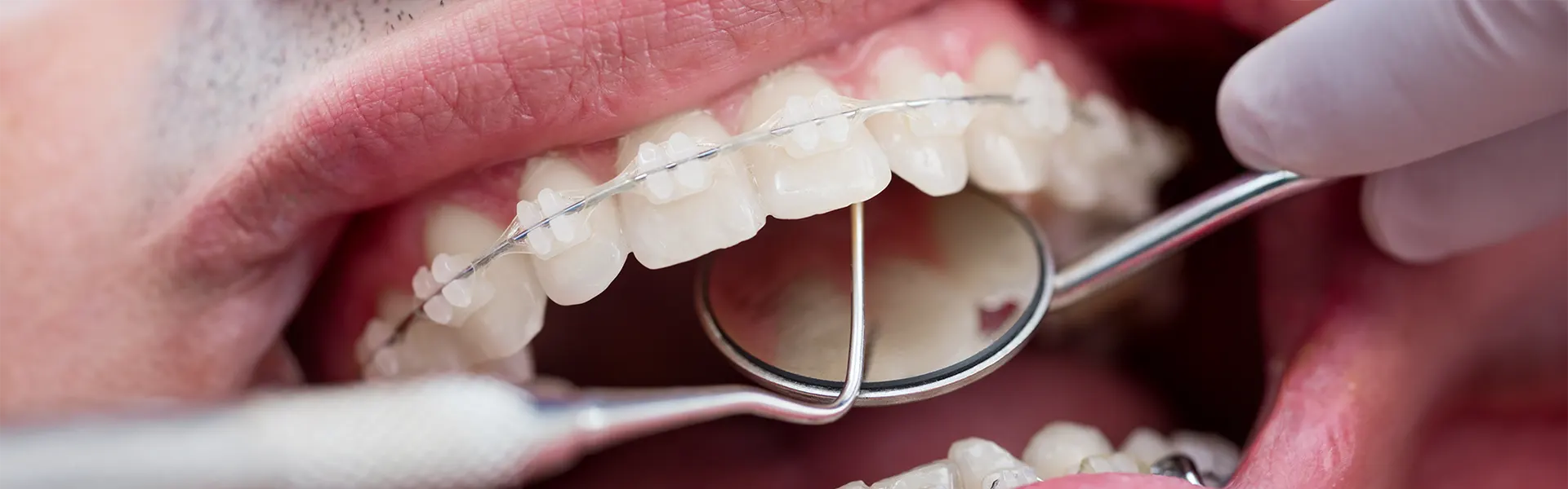 Irrigador bucal y ortodoncia invisible: lo que debes saber