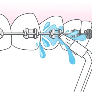 ¿Cómo limpiar tus brackets con un irrigador dental? Guía fácil
