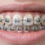 manchas-blancas-en-dientes-con-brackets